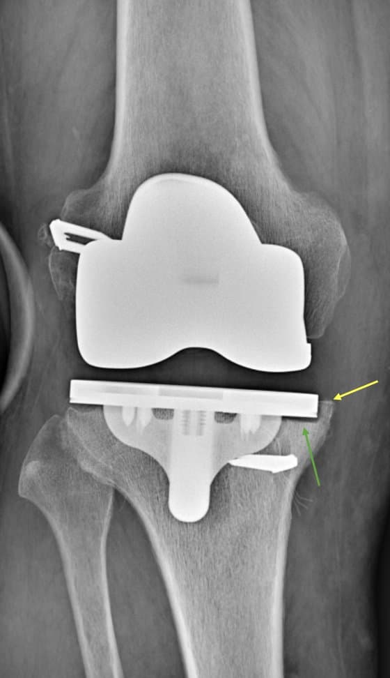 Radiographie d'un descellement de prothèse de genou : liseré entre la prothèse et l'os (flèche verte) et enfoncement de la prothèse (flèche jaune)