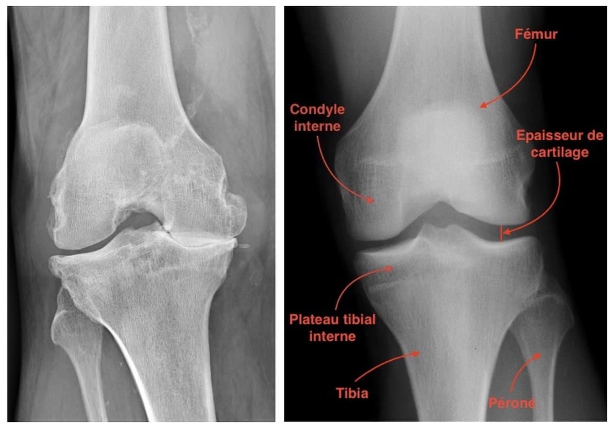 Radiographies comparées : genou normal avec interligne conservé et genou arthrosique avec pincement, disparition du cartilage et ostéophytes