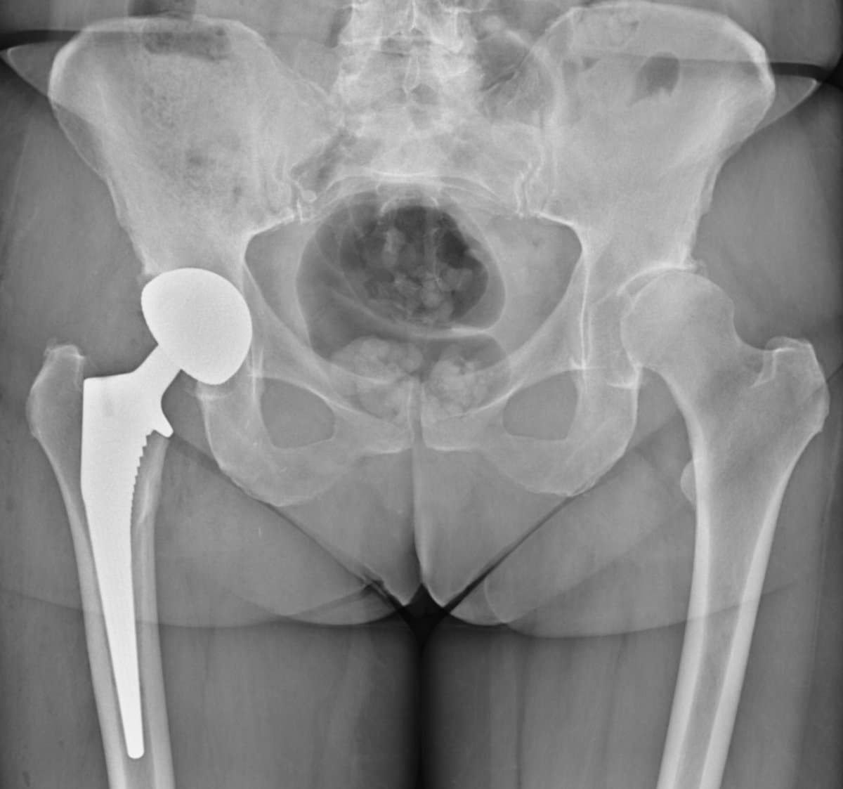 Radiographie du bassin après pose d'une prothèse totale de hanche