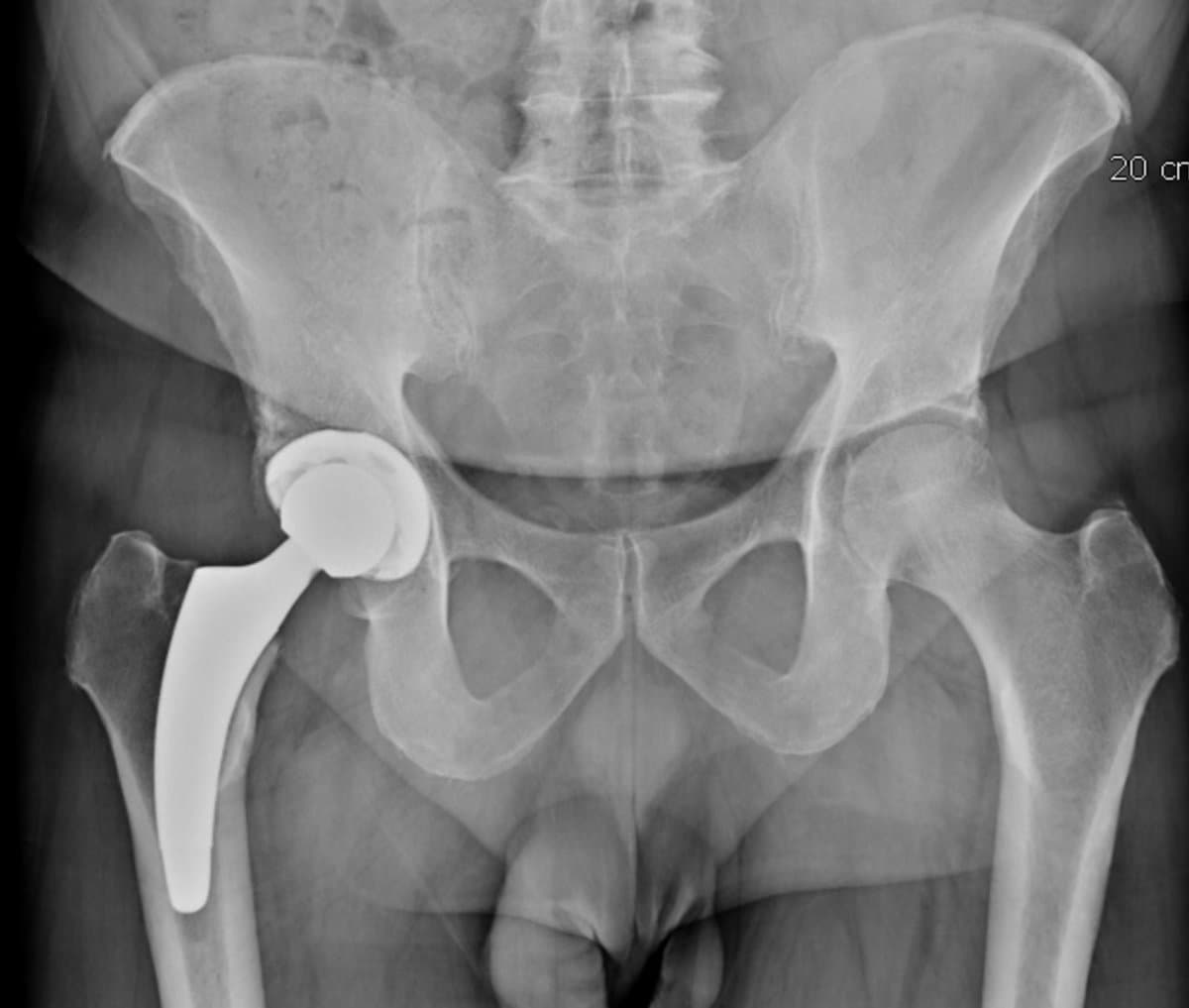 Radiographie du bassin après pose d'une prothèse totale de hanche