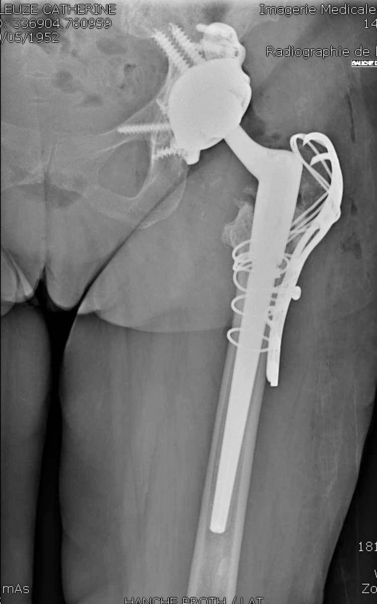 Radiographie d'une reprise complexe de prothèse de hanche avec prothèse longue, plaque, cerclages et cotyle sur mesure vissé
