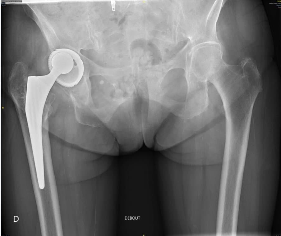 Radiographie d'une prothèse totale de hanche usée