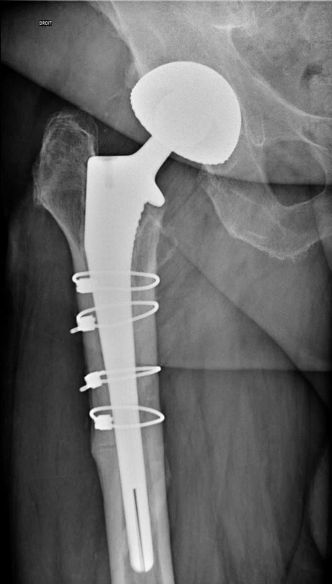 Radiographie d'une reprise de prothèse de hanche avec une tige fémorale plus longue