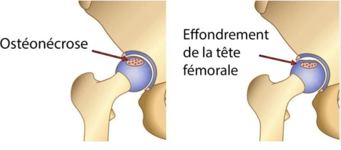 Schéma en deux temps : la zone d'ostéonécrose dans la tête fémorale, puis l'effondrement de la tête fémorale