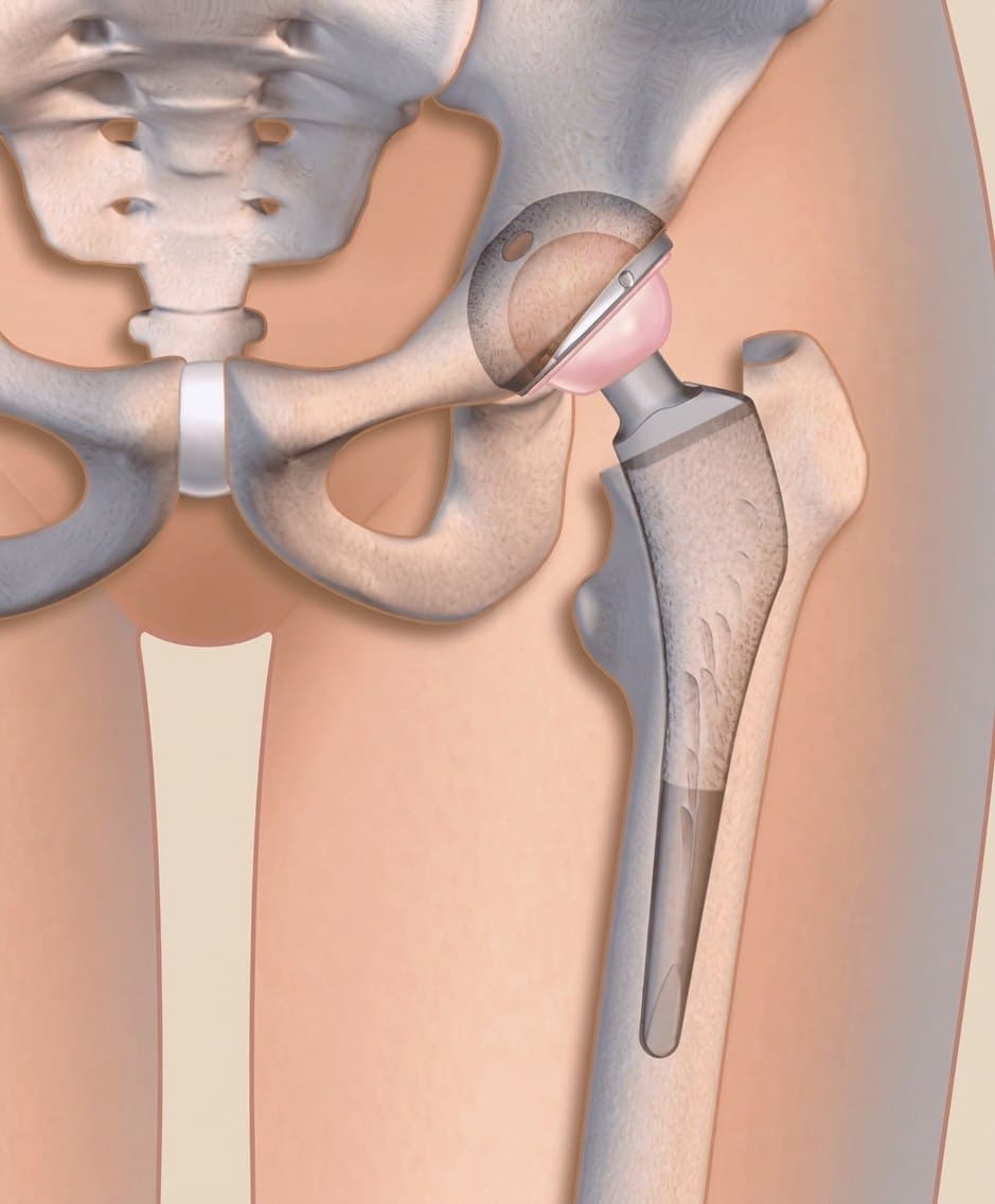 Illustration d'une prothèse totale de hanche en place dans l'anatomie du bassin et du fémur