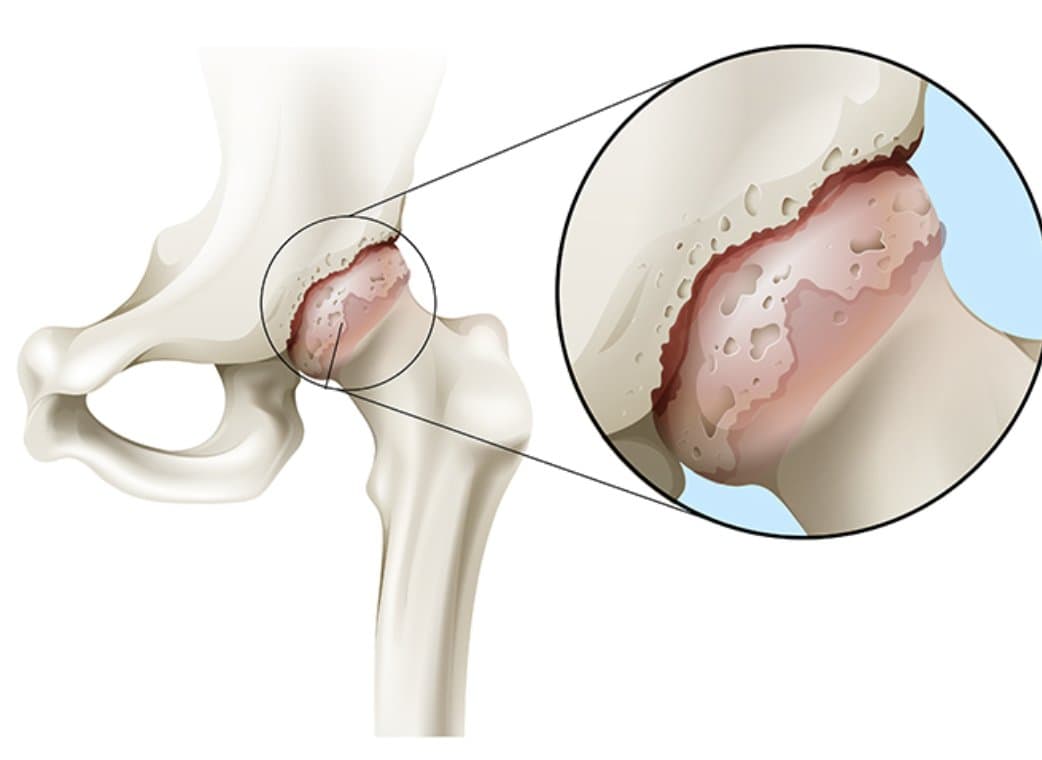 Illustration d'une hanche dont le cartilage s'érode, avec un zoom sur la surface du cartilage creusée de trous