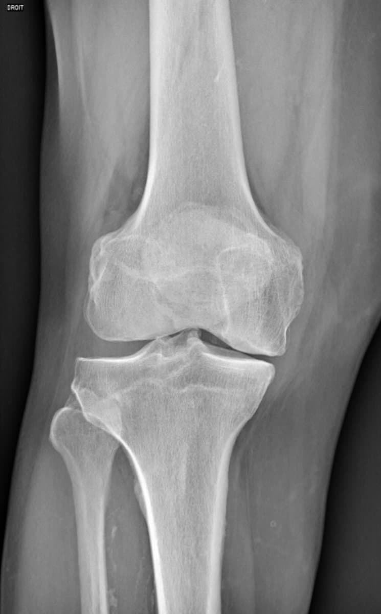 Radiographie d'une arthrose fémorotibiale interne : pincement du compartiment interne du genou, compartiment externe sain