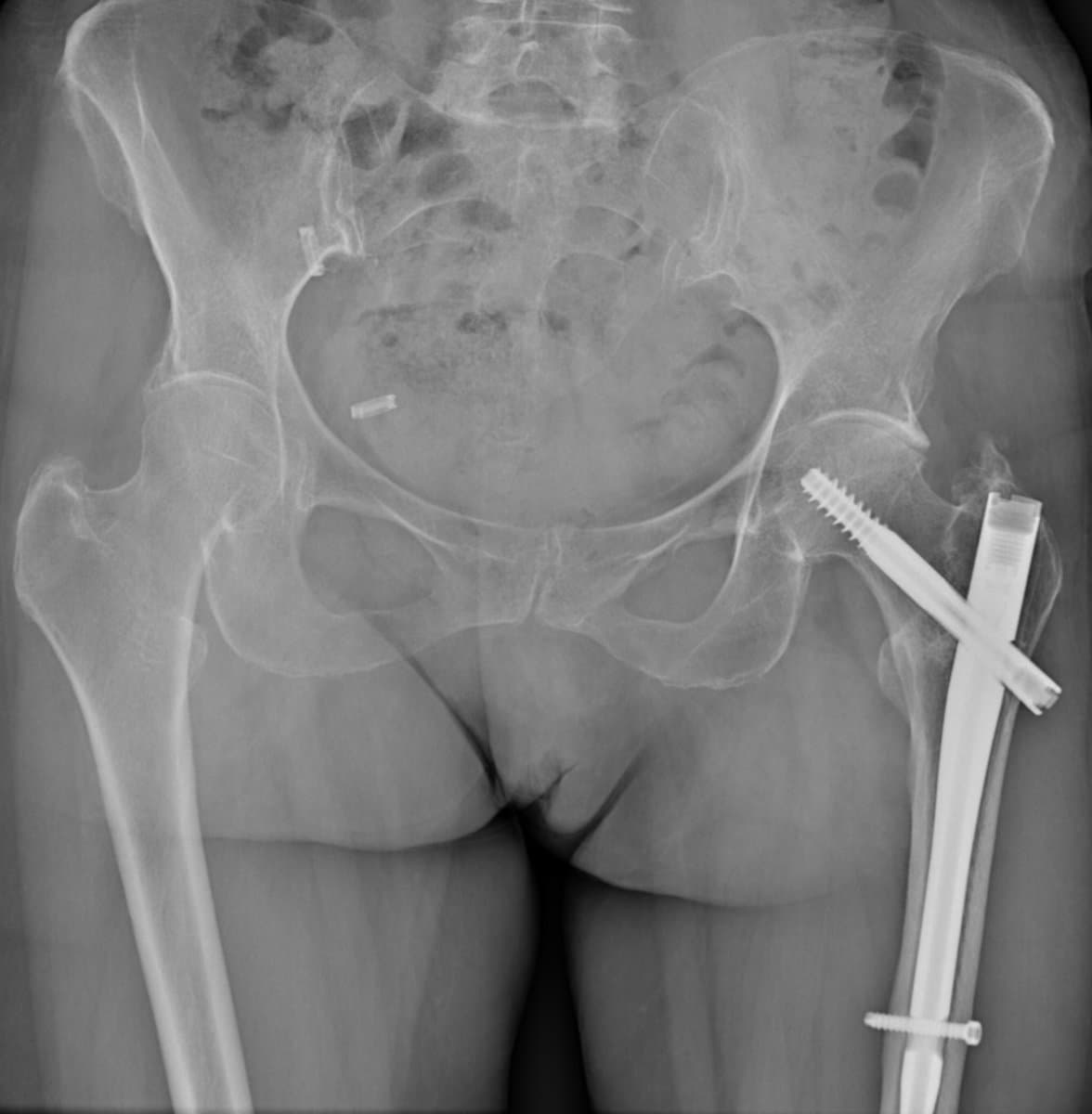 Radiographie d'une coxarthrose post-traumatique : hanche déjà opérée avec du matériel d'ostéosynthèse en place