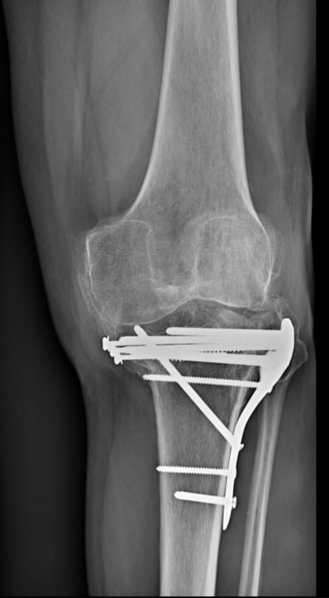 Radiographie d'une gonarthrose post-traumatique : genou déjà opéré avec du matériel d'ostéosynthèse en place
