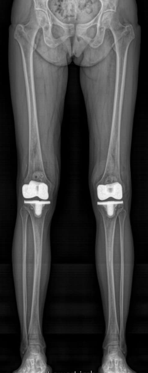 Radiographie post-opératoire d'un patient opéré des deux genoux en même temps, avec deux prothèses totales de genou