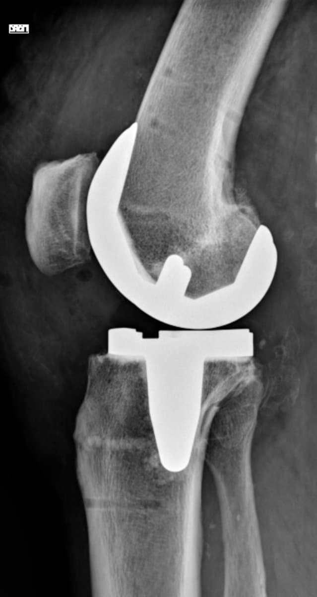 Radiographie de profil d'une prothèse totale de genou, montrant l'arrondi du fémur