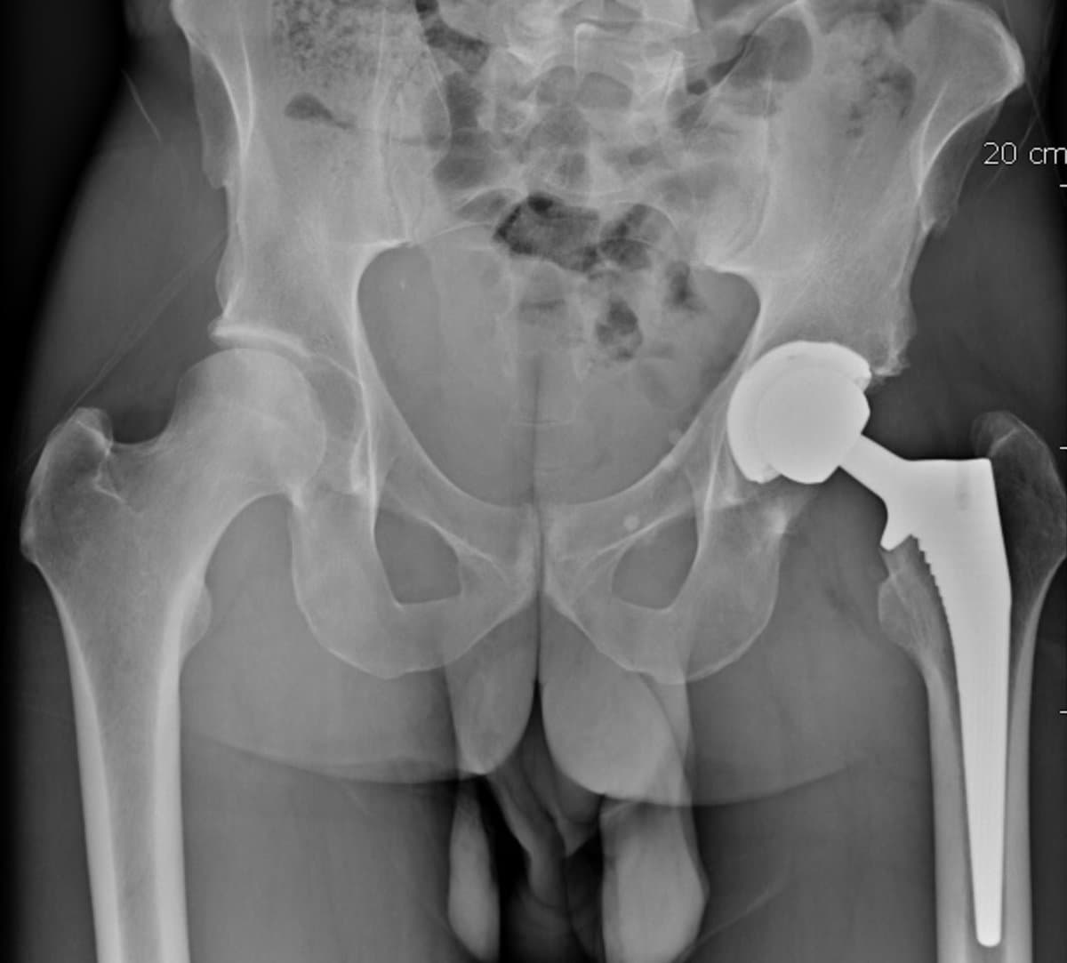 Radiographie du bassin après pose d'une prothèse totale de hanche